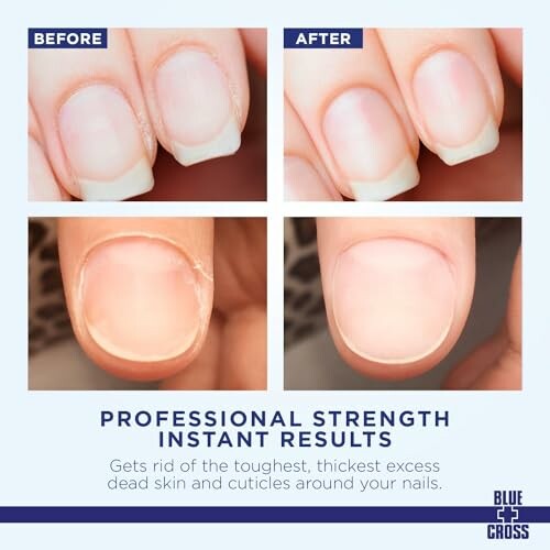 Before and after images showing nail cuticle treatment results.